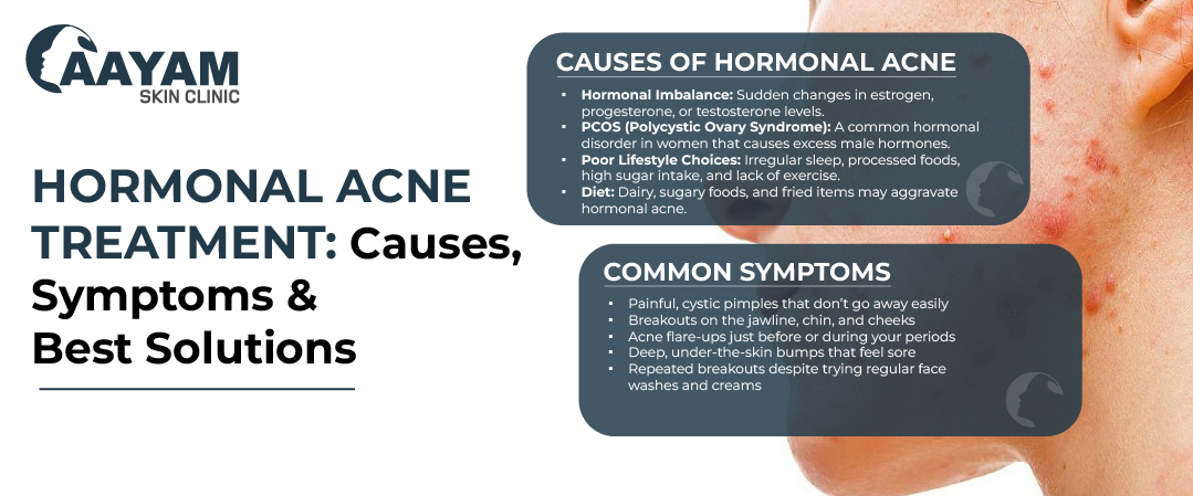 Hormonal Acne Treatment