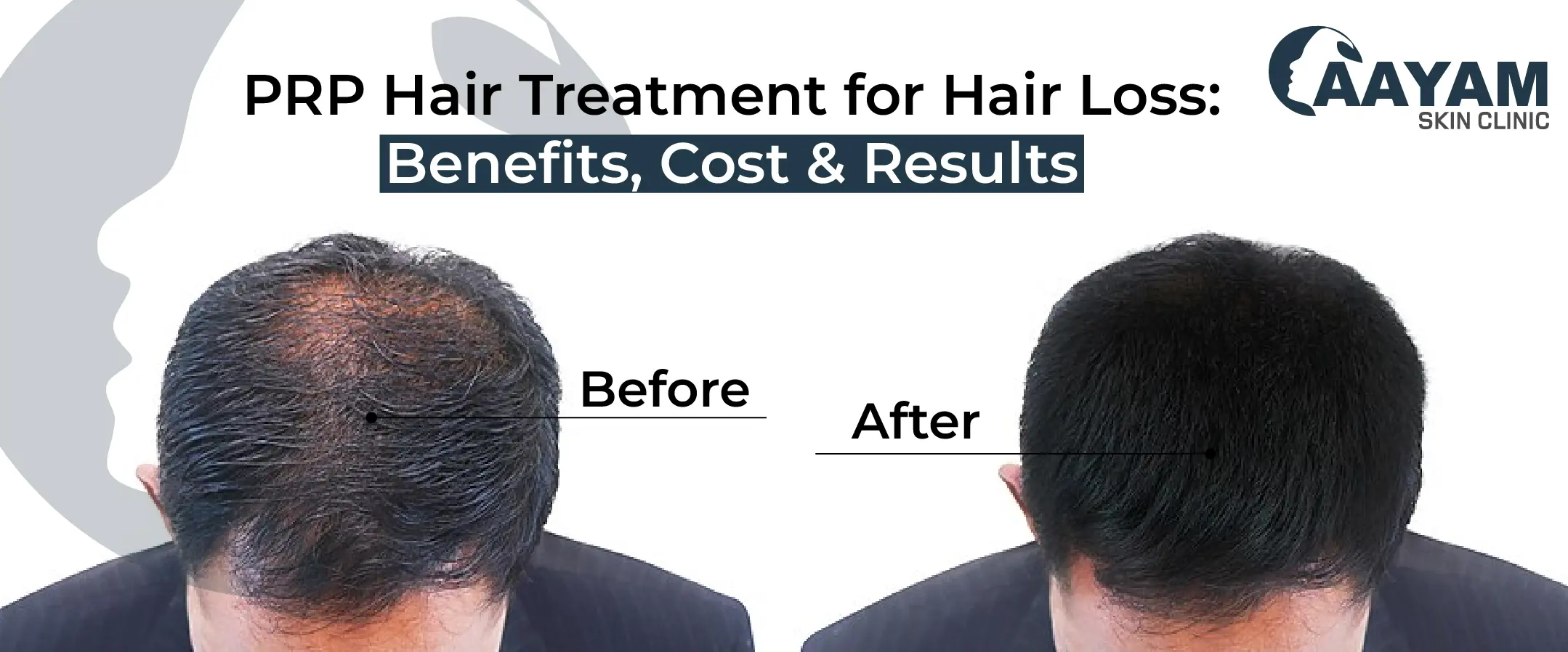 PRP Hair Treatment for Hair Loss