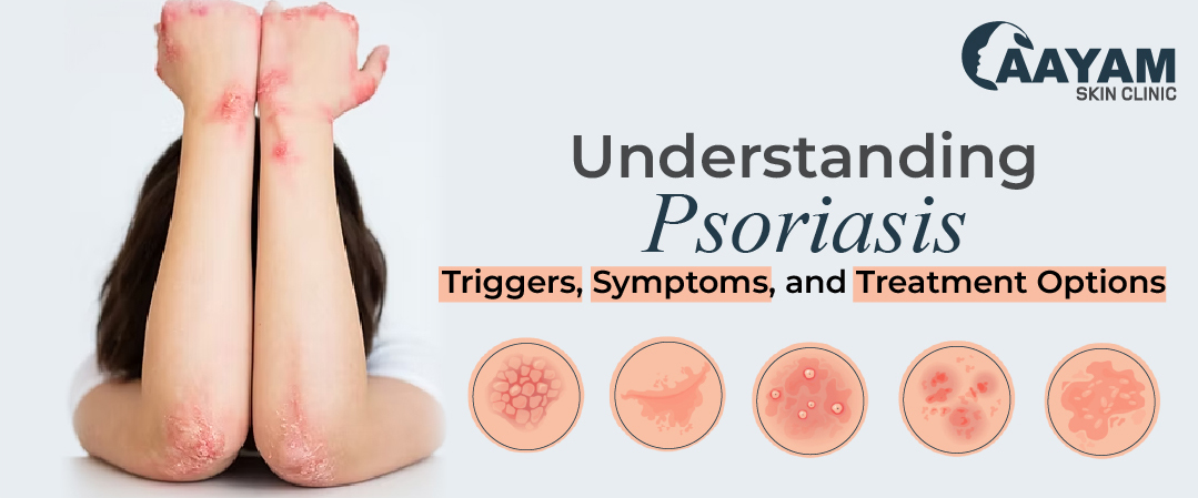 Psoriasis: Triggers, Symptoms, and Treatment Psoriasis: Triggers, Symptoms, and Treatment Options