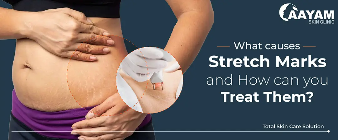 Stretch Marks on Skin