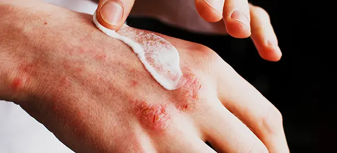 Eczema Treatment in Indore - Aayam Skin Clinic