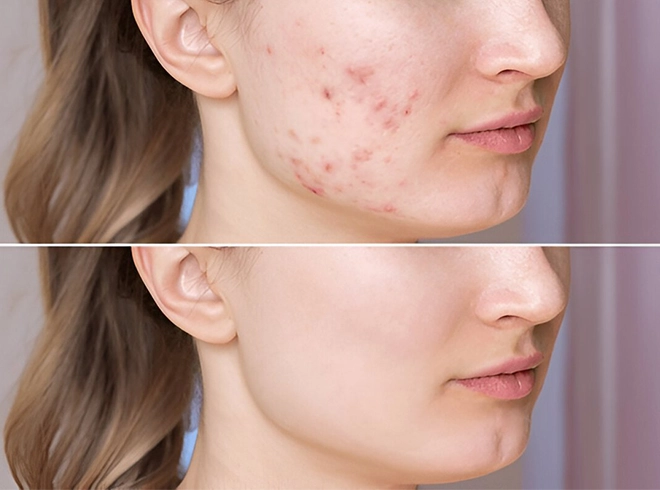 Acne Treatment
