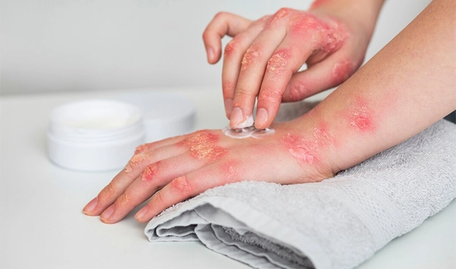 Eczema Treatment