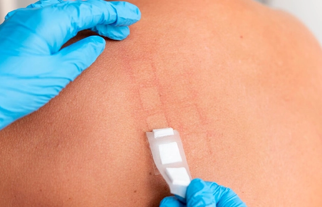Keloid Reduction