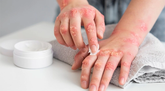 Psoriasis Treatment