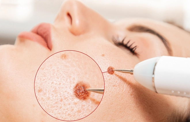 Wart Removal