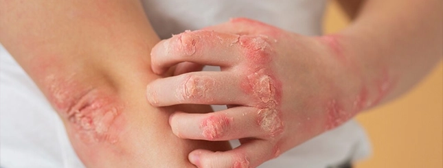 Skin Treatment in Indore - Aayam Skin Clinic