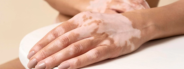 Skin Treatment in Indore - Aayam Skin Clinic