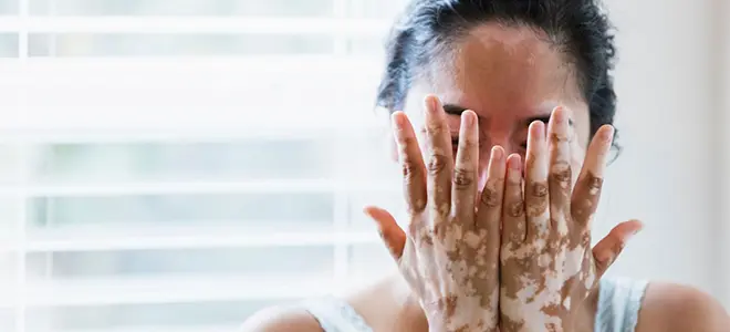 Best Vitiligo Treatment in Indore - Aayam Skin Clinic
